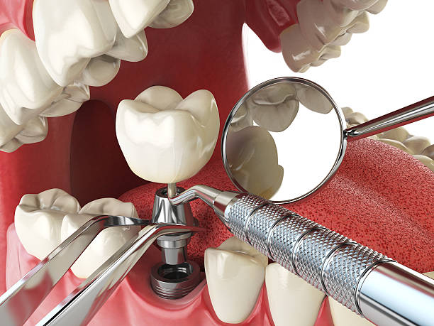 Best Emergency Tooth Extraction in East Moriches, NY